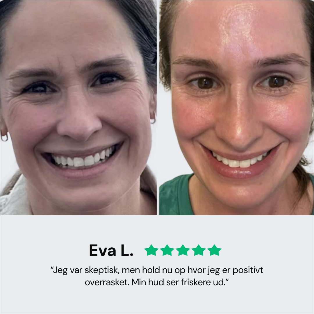 Revaje Microneedling System™