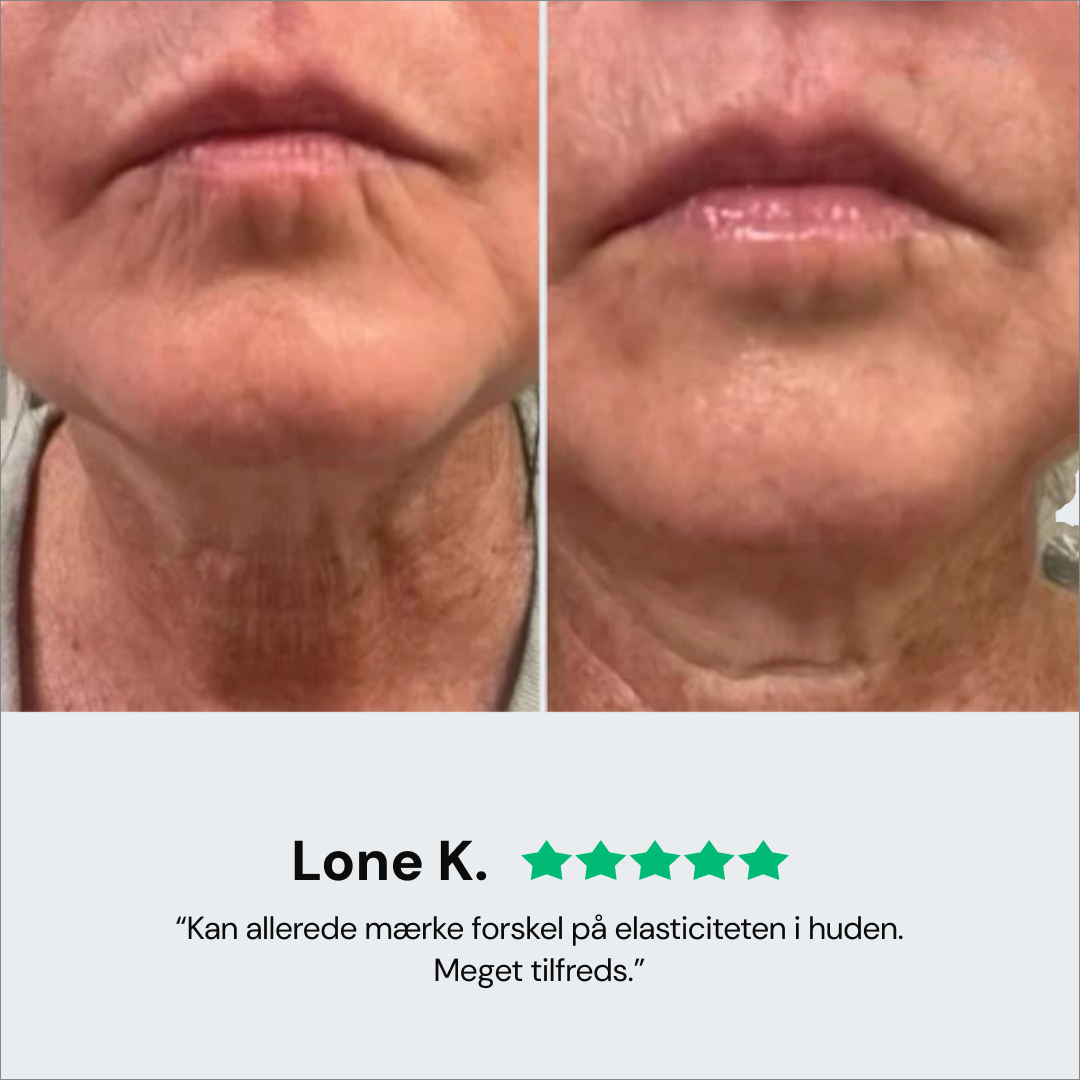 Revaje Microneedling System™