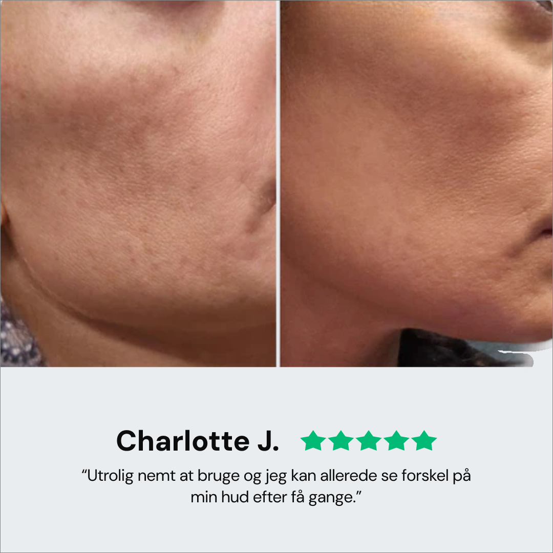 Revaje Microneedling System™